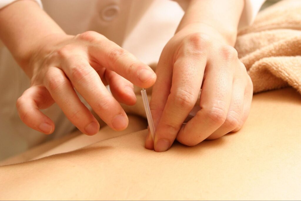 鍼灸 何に効く